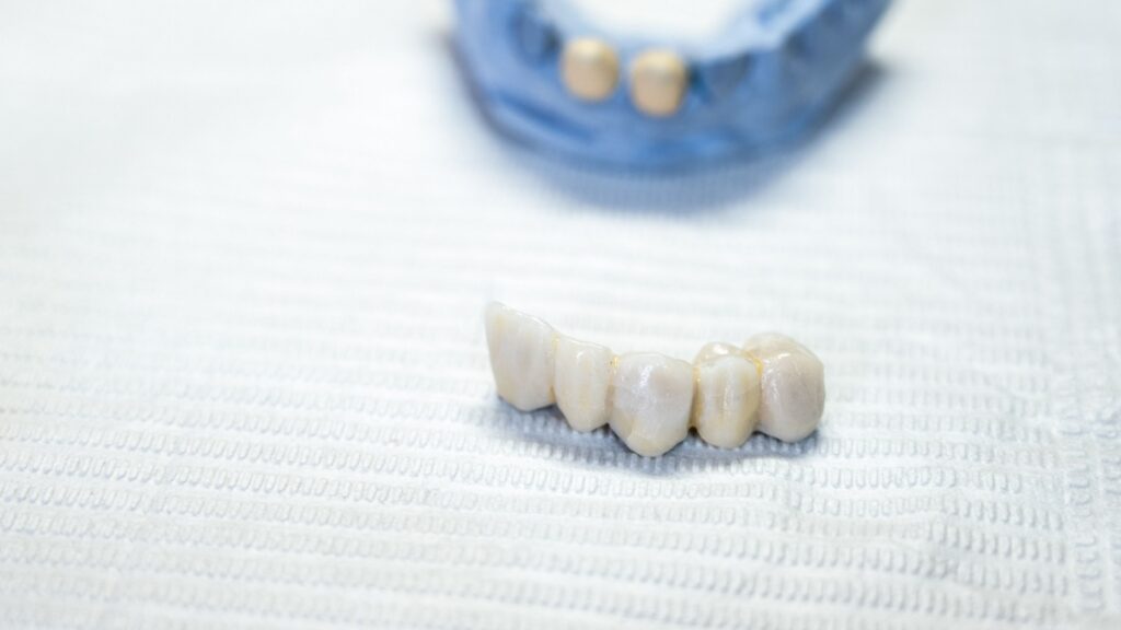 Cement retained dental bridge implant made in a digital dental lab.